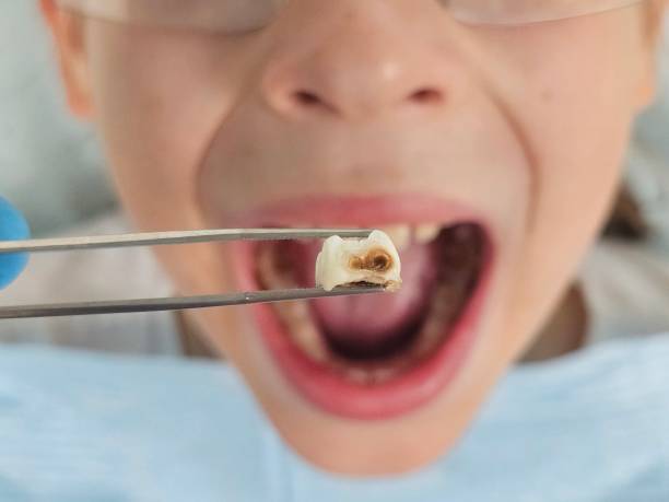 Best Teeth Whitening  in Delhi Hills, OH