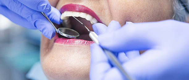 Best Chipped Tooth Repair Near Me  in Delhi Hills, OH