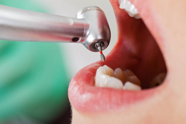 Best Dentist for Tooth Abscess  in Delhi Hills, OH